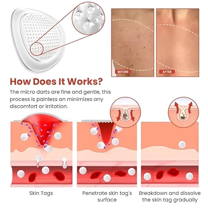 Skin tag patch placed flat on clean dry skin